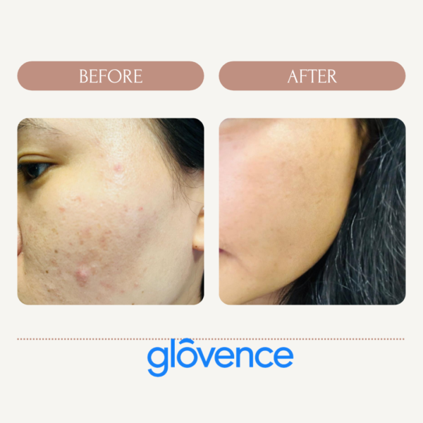 Glovence Gluta Glo Moisturizer & Squalane Sunscreen Combo - Image 9